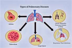Various types of pulmonary diseases. | Download Scientific Diagram