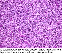 Aitl is generally a rapidly progressive disease. Pathology Outlines Atll
