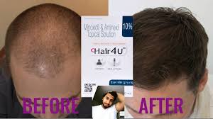 hair growth therapy by hair 4u