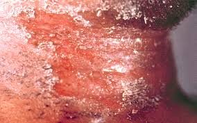 The clinical features of diphtheria are caused by a toxin. Diphtheria Photos Cdc