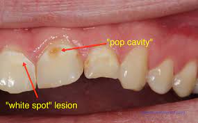 Because of its location front and center in the mouth, the dentist will usually recommend porcelain or composite resin as the filling material. Saginaw Dentist Talks About Pop Drinking And Cavities Mead Family Dental