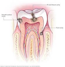 cavities tooth decay symptoms and causes mayo clinic