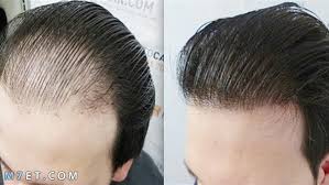 تكلفة زراعة الشعر في مصر
