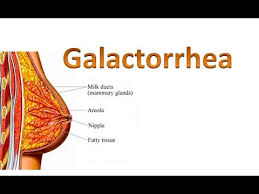 Image result for Galactorrhea