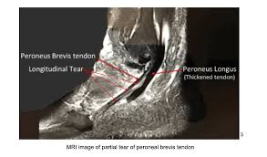 General anatomy and the musculoskeletal system: Peroneal Tendonitis Learn More About Peroneal Tendonitis