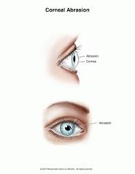 The Cornea Is The Clear Outer Coating Of The Front Of The Eye A Corneal Abrasion Occurs When The Outer Layer O Corneal Abrasion How To Apply Makeup Eye Health