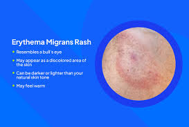 Image result for Lyme Carditis