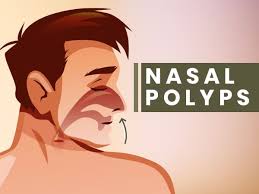 Unfortunately, quitting smoking often does not reverse the symptoms since permanent damage has been done to the nose. Nasal Polyps Is It A Serious Condition Know About Its Causes Symptoms And Treatment Boldsky Com