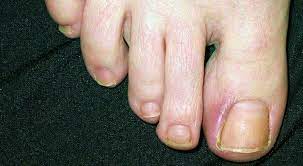 Most often a black spot that looks like you dropped something on your toe is an old hemorrhage from trauma. Patient With Supraglottic Squamous Cell Carcinoma Develops Painful Swelling On Both Great Toes