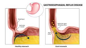 Esofagus atau kerongkongan adalah tabung (tube) berotot pada vertebrata yang dilalui sewaktu makanan mengalir dari bagian mulut ke dalam lambung. Penyakit Gerd Gejala Penyebab Pengobatan Klikdokter Com
