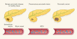 Not everyone will get all of the symptoms we've included in this section. Stem Cells For Pancreas Cancer Adenocarcinoma Immunotherapy