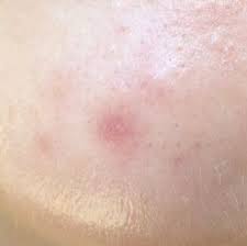 Locurile roșii care apar pe orice parte a corpului uman nu sunt doar un defect cosmetic, ci semnalează și o încălcare a corpului. Pete Post Acnee Metode De Prevenire Si Tratament