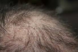 However, it seems to have a disadvantage concerning hair health. Does Creatine Causes Hair Loss Stylish Made