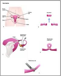 Tubal Ligation Procedure Recovery Blood Tube Pain Complications Time Infection