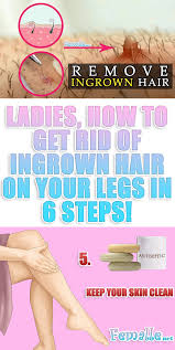 Wash the area with mild soap and warm water. Ladies How To Get Rid Of Ingrown Hair On Your Legs In 6 Steps Ingrown Leg Hair Ingrown Hair Ingrown Hair Removal