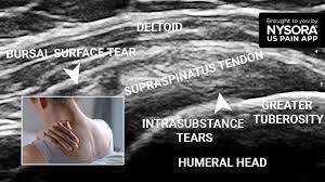 Image result for Subacromial Space Injection