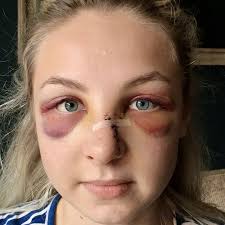 Boy, 16, who left officer's nose 'hanging off' in savage attack avoids  prison