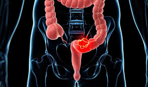 Fortunately, colon cancer rates have dropped over the last ten years due to the rise in colonoscopies and colon cancer screenings. Bowel Cancer Symptoms Signs Of A Tumour Include Having Itchy Skin Express Co Uk