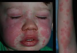 Image result for Erythema Multiforme Major