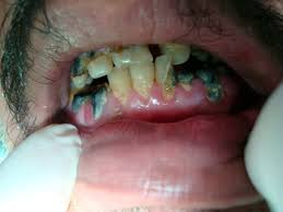 Image result for granuloma gum disease