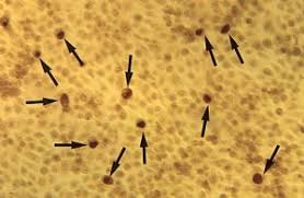 Image result for Chlamydia Trachomatis