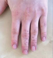 There are those that can be removed by the fingers. Granulomatous Reaction After Cholla Cactus Spine Injury Mdedge Dermatology