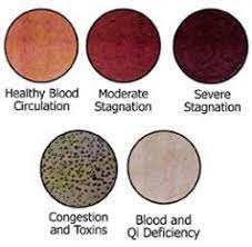 What are the side effects of cupping marks? Understanding Cupping And The Meaning Of The Marks Left Behind Chelsea Natural Health Clinic