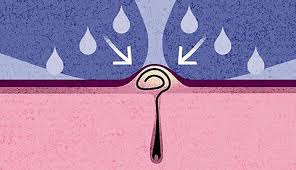 When infected, they can become abscesses or boils. How To Get Rid Of An Ingrown Pubic Hair On Your Vagina