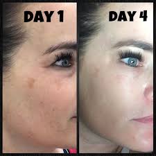 The skin is especially sensitive after a chemical peel. Contour Dermatology Why Chemical Peels Are So A Peel Ing Contour Dermatology