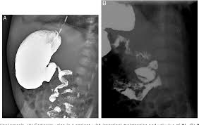 Image result for Midgut Volvulus