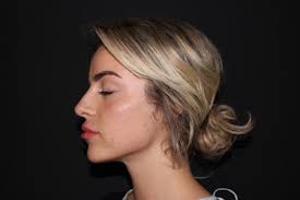 eilishflesch neuscorrectie bij Esteworld beste keus ooit!