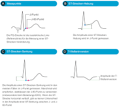 If cardiac troponin levels are normal, the condition is classified as unstable angina pectoris, which thus can be viewed as an impending myocardial infarction (figures 1 & 2). Klassifikation Von Akuten Koronarsyndromen Acs Und Akutem Myokardinfarkt Ami Ekg Echo