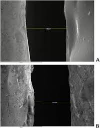 Maybe you would like to learn more about one of these? Effect Of Cementation And Aging On The Marginal Fit Of Veneered And Monolithic Zirconia And Metal Ceramic Cad Cam Crowns Journal Of Prosthetic Dentistry
