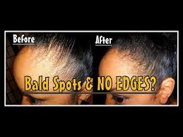 Short hair preserves natural volume in. Rocking Short Natural Hair With Thin Edges Try This Instant Fix Curlynikki Natural Hair Care