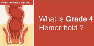 There are things you can do to treat and prevent treatment without surgery. What Is Grade 4 Hemorrhoid How To Treat This Piles Condition