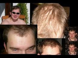 Sodium lauryl sulfate (sls) is a harsh chemical detergent and surfactant used in many commercial shampoos to strip away dirt, oil, and other impurities, while also creating the rich lather we're all used to getting from shampoos. Hair Styling And Hair Loss Youtube
