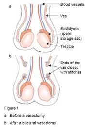 Vasectomy Procedure Cost Effectiveness Vasectomy Female Sterilization Contraception Methods