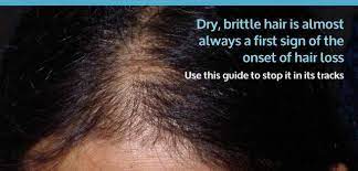 You probably have brittle hair which according to dr sharad, brittle hair is generally caused by various chemical and physical treatments done to the hair fibre such as excessive curling. Dry Brittle Hair How To Prevent Hair Loss And Nourish The Hair Nicehair Org
