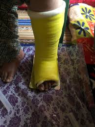 Image result for Short Leg Cast