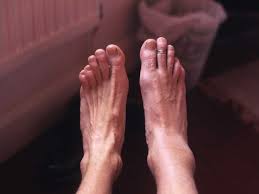 The color is different from the rest of your skin. Subtle Signs Of Prostate Cancer