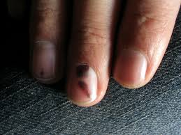 These are three different causes that need completely different types of treatment! Here S What The Color Of Your Toenails Mean