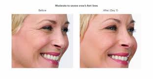 We did not find results for: The Botox Brow Lift Elgin Il Om Medispa