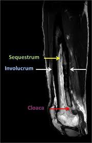 Image result for Osteomyelitis Bone Scan
