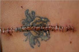A deep review of the research on skin cancer and tattoos published in the lancet. Can Tattoos Give U Skin Cancer Ask The Expert Can A Tattoo Increase Skin Cancer Risk The Skin Cancer Foundation Tattoos Breach The Skin Which Means That Skin Infections And