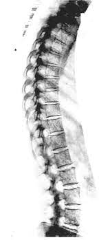 Osteoporose Hormoninstitut Dobnig