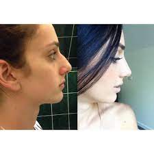 Maybe you would like to learn more about one of these? 270 Likes 37 Comments Cosmeditour Cosmeditour On Instagram Before And After Nose Correction Surgery Rhinoplasty Plastic Surgery Nose Plastic Surgery