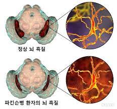 의학신문·일간보사=안치영 기자 국내 연구진이 파킨슨병 및 파킨슨 증후군에서의 뇌 자기공명영상(mri)의 최신 지견을 집대성한 리뷰 논문(종설)을 발표했다.분당서울대병원 신경과 김종민 교수와 영상의학과 배윤정 교수를 주축으로 한 파킨슨병 연구팀은 최근 영상의학 분야 최고 권위 국제. íŒŒí‚¨ìŠ¨ë³' ì§„í–‰ì„± í•µìƒì•ˆê·¼ë§ˆë¹„ ë„íŒŒë¯¼