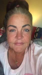 Well second half dose of Ocrevus is in the books. Hot red face is truly a  thing while the infusion happens. Exhaustion is true during the infusion.  Appreciate all of the posts