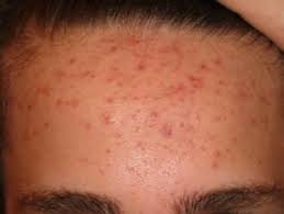 To get rid of these unwanted forehead bumps, you have to remove unwanted particles clogged in your skin. Forehead Acne Causes And Treatments Mdacne