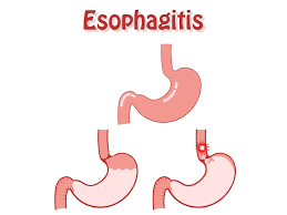 Hospitalization For Ibd Does Not Improve Pain Outcomes